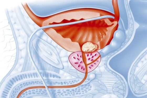 Proceso inflamatorio en la próstata.