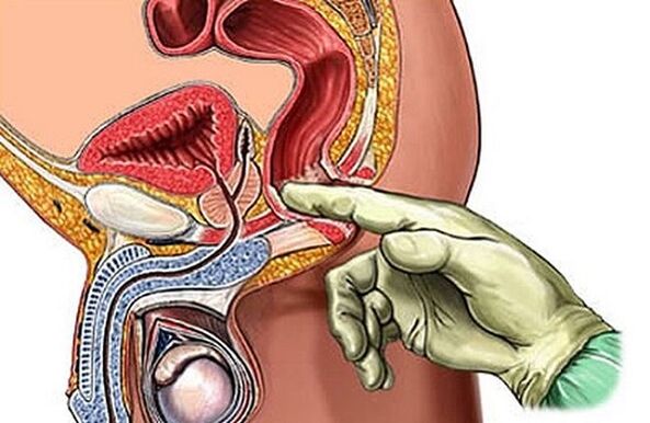 El masaje de próstata como forma de tratar la prostatitis.