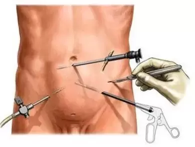 tratamiento quirúrgico de la prostatitis crónica