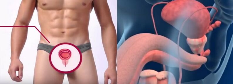 Prostatitis en hombres, reconocible por ciertos signos.