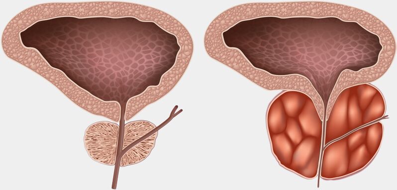 próstata sana e inflamada con prostatitis