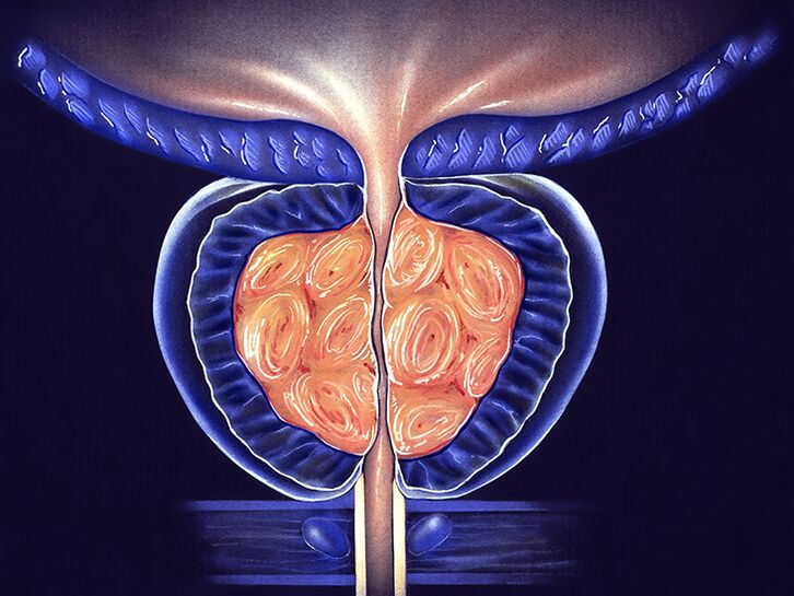 prostatitis y próstata inflamada prevención