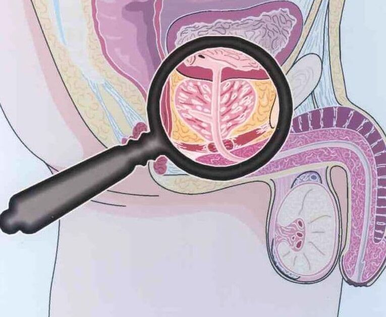 Derrota del tejido prostático en pacientes con prostatitis crónica hombres. 