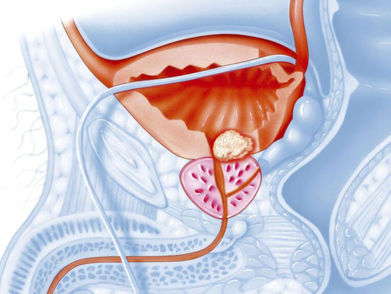 En la prostatitis crónica, la luz de la uretra se estrecha, lo que dificulta que la orina fluya. 