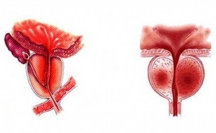 Inflamación aguda de la glándula prostática, que puede volverse crónica